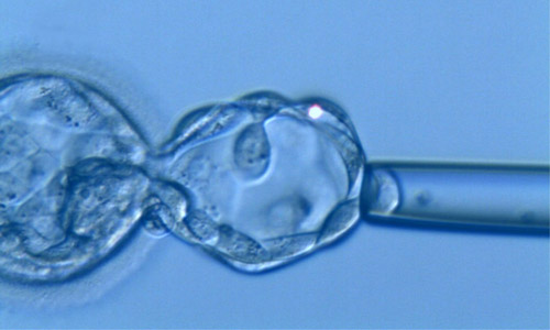 DGP - Biopsia embrionale effettuata allo stadio di blastocisti